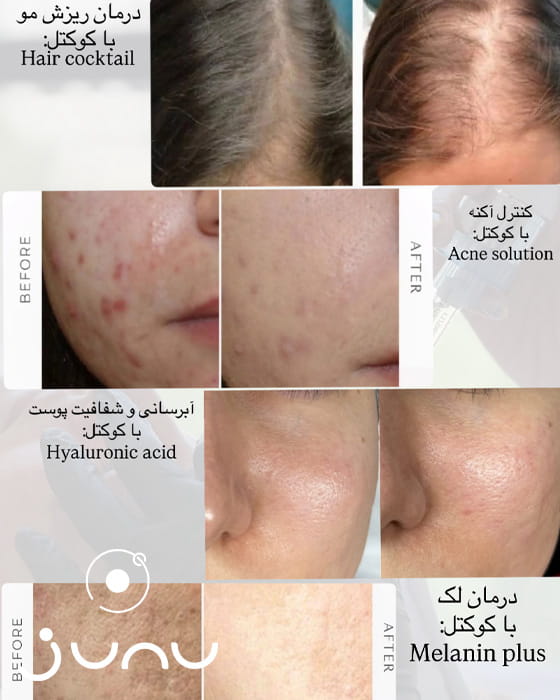 نمونه قبل و بعد فیشیال در شمال تهران